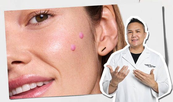 Close-up of a smiling woman's face with pink pimple patches applied near her cheekbone, alongside a skincare expert in a white lab coat gesturing in presentation.
