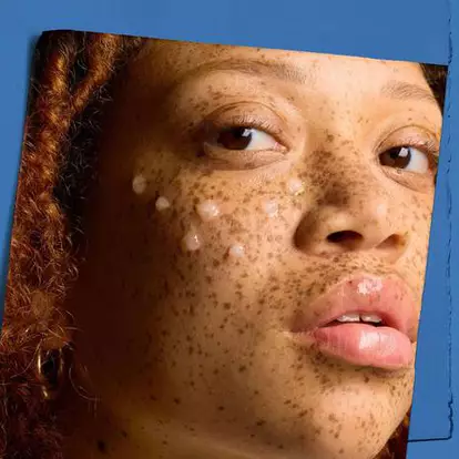 Close-up of a woman's face with freckles and curly hair, applying skincare dots on her cheek. The background is blue, adding a calm tone to the image.